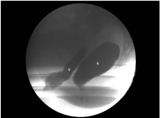 Figura 5 – Paciente 6 – visão  do monitor do equipamento de fluoroscopia  telecomandado, com contraste na vagina (V) e no reto (R), na  fase de repouso.