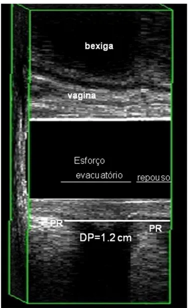 Figura 7 – Paciente 20 – ECD – descenso perineal ≤  2.5  cm . Descenso perineal normal