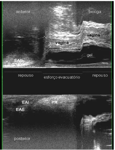 Figura 9 – Paciente 8 – ECD – ausência de retocele. EAE – esfíncter anal  externo; EAI – esfíncter anal interno; PR – músculo pubo-retal.
