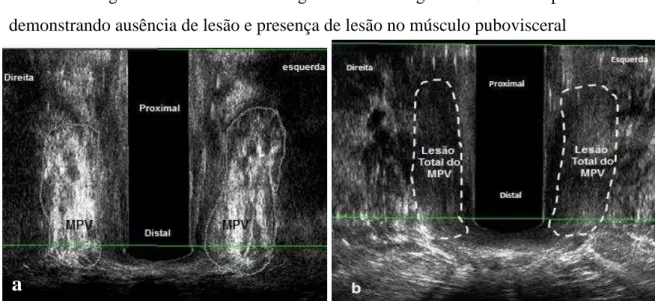 Figura  11  –   Ultrassonografias  endovaginais  3D  no  plano  coronal  demonstrando ausência de lesão e presença de lesão no músculo pubovisceral 