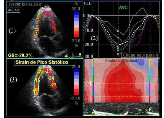 Figura 7 - Tela do  software  para avaliação do  speckle-tracking  com a imagem bidimensional  (1), o traçado do parâmetro analisado (2), o valor médio do  strain  de pico sistólico em cada  segmento do VE avaliado (3) e a imagem paramétrica colorida obtid