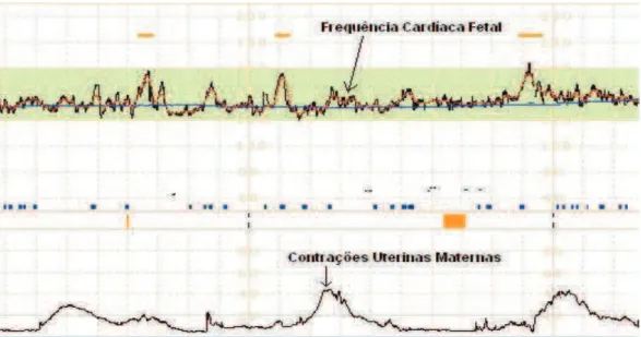 Figura 2 - Sinais da Frequência Cardíaca Fetal e Contrações Uterinas em uma CTG 