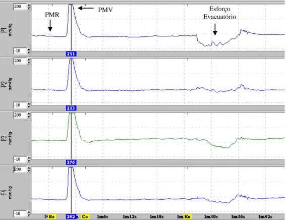 Figura 3  –  Grupo I  –  Registro simultâneo do exame eletromanométrico em quatro canais com PMR,                     PVM e Esforço Evacuatório em pacientes com relaxamento dos músculos PR / EAE