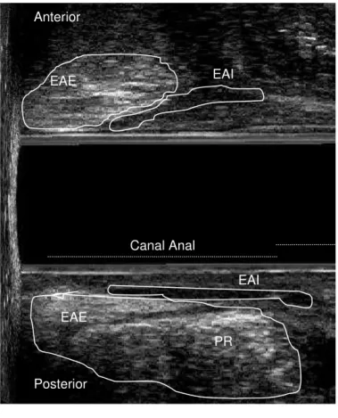 Figura 7  –  Ultra-sonografia anorretal. Canal anal feminino ( Plano LM ). Avaliação da musculatura esfincteriana