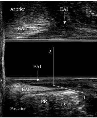 Figura 8  –  Ultra-sonografia anorretal. Plano LM  –  Paciente normal em repouso. Ângulo formado pela                     confluência de uma linha traçada paralela à borda interna do PR (1) com uma outra vertical,                      longitudinal ao eixo 