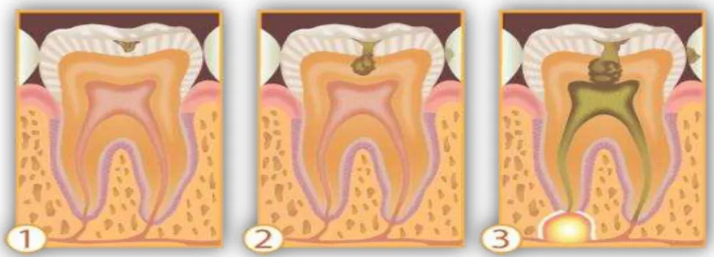 FIGURA 3 - Progressão da cárie dentária.  