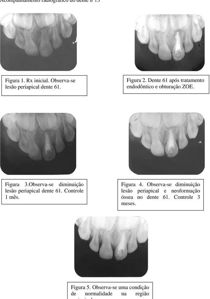 Figura 2. Dente 61 após tratamento  endodôntico e obturação ZOE. 