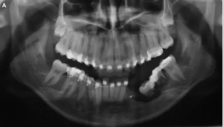 FIGURE 3. Radiographs after transplantation of the lower third molars to the region of the first molar and second premolar