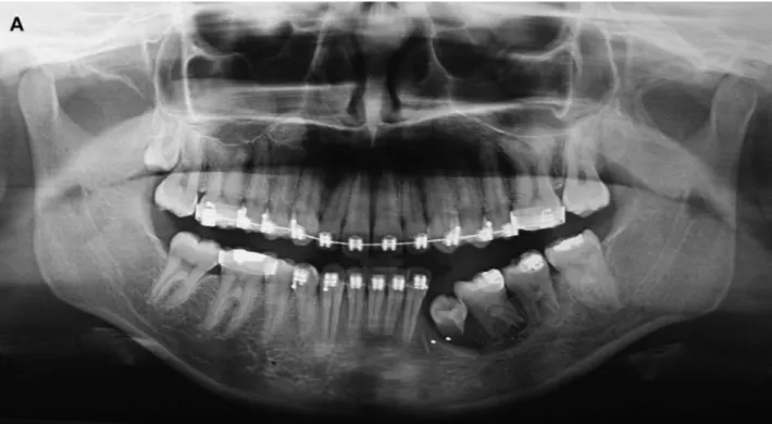 FIGURE 4. Radiographs after transplantation of the upper third molar to the canine region