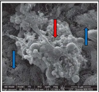 FIGURA 4. Biofilme bacteriano  (seta vermelha)  colonizando o tecido ciliado  (setas azuis)  da mucosa  nasal de  um paciente com rinossinusite crônica
