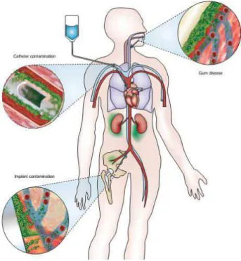 Figura  9  –   Esquema  demostrando  três  possíveis  locais  de  formação  de  biofilmes  causadores  de  infecções:  cateteres,  implantes  médicos  e  doença  periodontal   (HALL-STOODLEY; COSTERTON; STOODLEY, 2004)