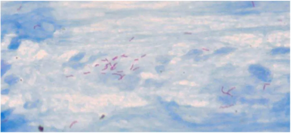 Figura 2 - Visualização dos bacilos de M. tuberculosis em esfregaço de escarro através da coloração  de Ziehl-Neelsen
