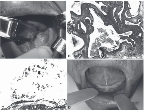 Figure 1. (A) Intraoral examination showing swelling of the left floor of the mouth. (B) Histological sections showing multilocu- multilocu-lar cystic lesion lined by epithelium with papilmultilocu-lary projections and columnar, cuboid, and oncocytic cells