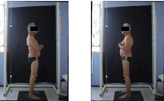 Figura 8. Fotografias realizadas na vista lateral direita e esquerda para análise postural