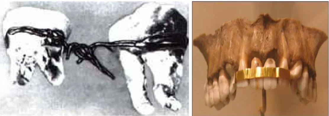 Figura 2.1 - a) dentes unidos com fio de ouro.  b) dentadura fixa etrusca (Viegas, 2007)