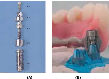 Figura 2.9 - (A) Componentes de um sistema Branemark: (a) implante, (b) pilar prolongador, (c)  parafuso do pilar, (d) cilindro, (e) parafuso (Spiekermann, 1995), (B) Barra protética instalada 