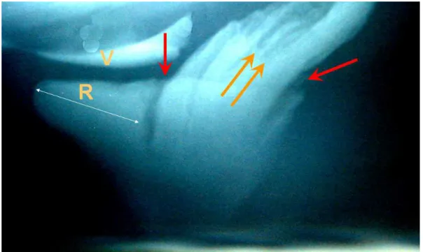 Figura  16  –  Filme  estático  de  cinedefecografia  revela  volumosa  anorretocele (R), prolapso mucoso (setas amarelas) e intussuscepção  reto-anal (setas vermelhas)