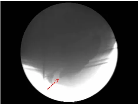 Figura  17:  Captura  de  tela  de  PED  em  fase  dinâmica.  Observar  anorretocele em repouso (seta)