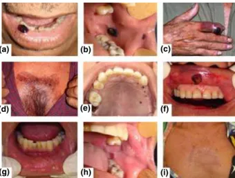 Figure 1 (a) Lower lip showing haemorrhagic blister. (b) Haemor- Haemor-rhagic blisters observed on the left buccal mucosa