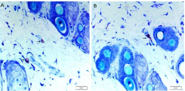 Figura  3:  Fotomicrografias  mostrando  distribuição  de  mastócitos  no  tecido  cicatricial  no  grupo  que  recebeu  dieta  hipercalórica  e  álcool  (G5),  nos  períodos  F2  e  F3  (células  coradas  em púrpura), no (A e B)
