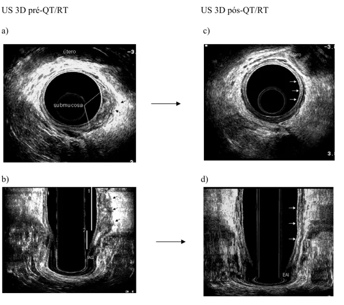 Figura 9 – Resposta completa: a (plano axial), b (plano coronal) – uT3 - Tumor no reto inferior  em paciente sexo feminina, localizada no quadrante lateral esquerda