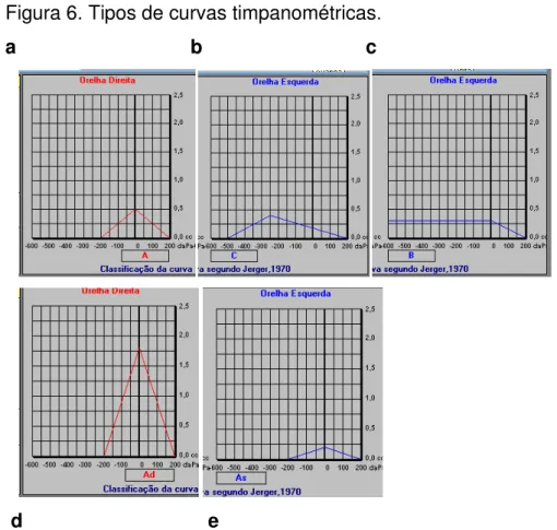 Figura 6. Tipos de curvas timpanométricas . 