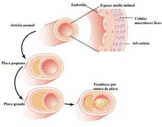 FIGURA 3: O endotélio e a evolução da placa aterosclerótica. FONTE: GUYTON e HALL, 