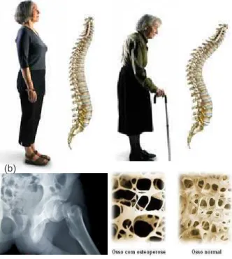 Figura 3: (a)Postura de uma pessoa com osteoporose. (b)Radiografia de uma fratura na bacia e a comparação entre um osso normal e com osteoporose.