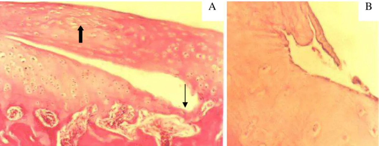Figura 3 - Secções da cartilagem articular do fêmur de animais do GCIII. A) Fissura  atingindo o osso subcondral (seta fina) e desorganização celular (seta  grossa) (HE, 83,3X)