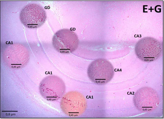 Figura  7  -  Grupo  V.  Características  celulares  das  regiões  do  hipocampo  na  rata  estressada  mais  aplicação  do  glicocorticoide,  Dexametasona,  Observe-se  a  marcada morte  neuronal  especialmente  em  CA1  e  CA3  e  a  dispersão  celular  