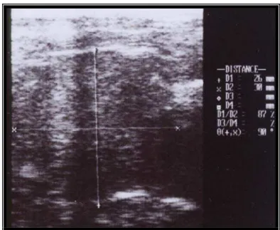 Figura 4. Imagem ultra-sonográfica longitudinal da glândula 