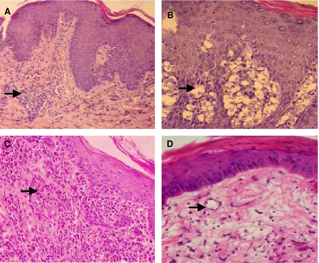 Figura 3:  Pele de cães naturalmente infectados por  L. chagasi. A- Pele de cão  sintomático do grupo I apresentando intenso infiltrado inflamatório (seta),  260X; B- presença de formas amastigotas do parasita no interior de  macrófagos (seta), 460X; C  - 