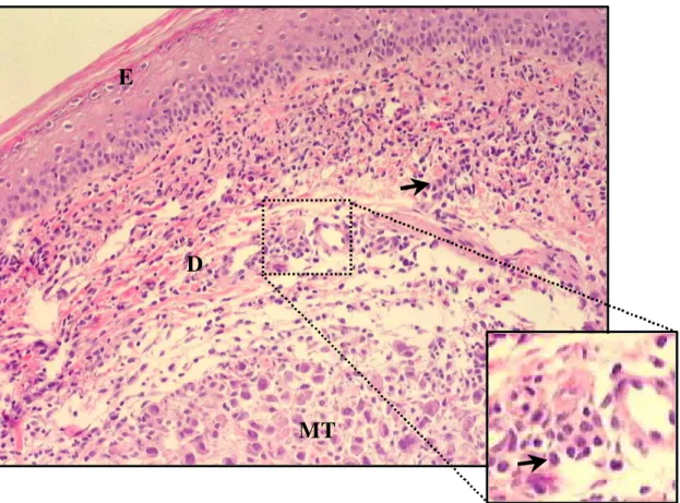 Figura 5.  Crescimento do tumor ascítico de Ehrlich no coxim plantar,  mostrando infiltrado inflamatório (seta) e massa tumoral (MT)  invadindo a derme (D)