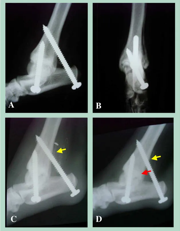 Figura 6 –  Aspectos radiográficos da artrodese tibiotársica induzida pelo uso de parafusos de aço inoxidável  304L auto-atarraxantes, imediatamente após o procedimento cirúrgico (A e B), aos 15 (C) e aos 30 dias (D) de  pós-operatório