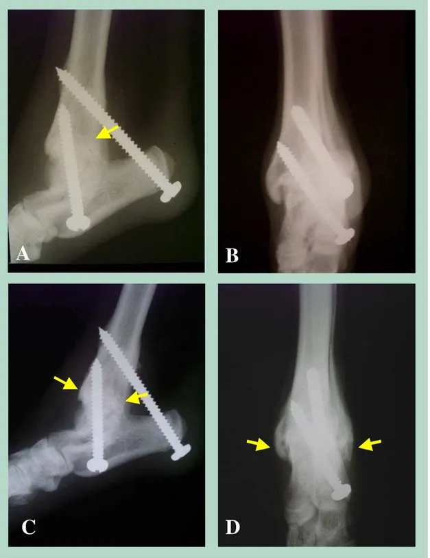 Figura 7 –  Aspectos radiográficos da artrodese tibiotársica induzida pelo uso de parafusos de aço inoxidável  304L auto-atarraxantes, aos 45 dias (A e B) e aos 60 dias (C e D) após o procedimento cirúrgico