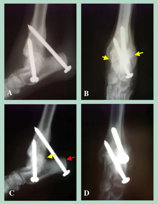 Figura 8 –  Aspectos radiográficos da artrodese tibiotársica induzida pelo uso de parafusos de aço inoxidável  304L auto-atarraxantes, aos 90 dias (A e B) e aos 120 dias (C e D) após o procedimento cirúrgico