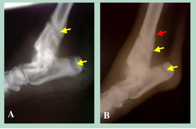 Figura 9 – Aspectos radiográficos imediatamente após o procedimento cirúrgico para retirada dos implantes (A)  e aos 30 dias (B)