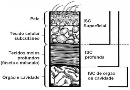 Figura 1 – Plano de infecção da ferida cirúrgica (corte transversal da parede abdominal  separado de acordo com a classificação de infecção de sítio cirúrgico)