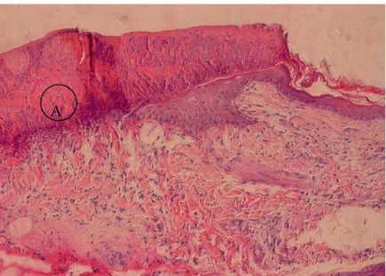 Figura 10. Aspecto da crosta densa observado no Grupo Tes, no 2° dia pós-cirúrgico.  Aumento de 20, coloração Hematoxilina e Eosina 