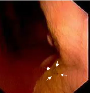 Figura 8 – Úlceras na mucosa gástrica aglandular do pônei de nº III, que recebeu a dose  diária de 6 mg kg -1  de monofenilbutazona