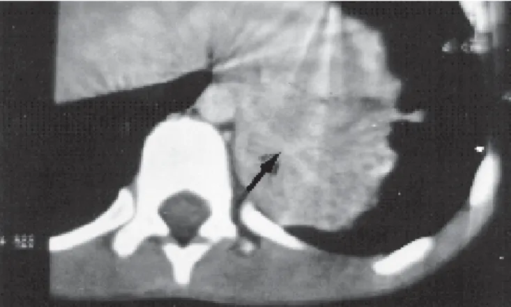 Figura 10 – Tomografia de tórax mostra condensação de lobo inferior esquerdo. Durante a injeção de contraste foi possível evidenciar a  pre-sença de vaso anômalo compatível com seqüestração pulmonar