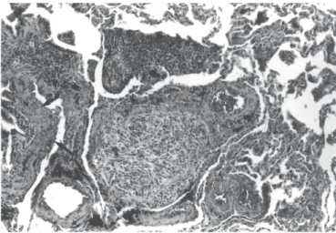Figura 1 Tomografia pulmonar de alta resolução de aspecto normal