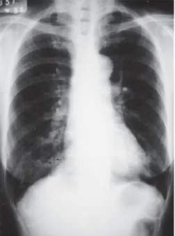 Figura 1 Bronquiectasia cilíndrica (mulher,  62 anos). Radiografia de tórax em PA mostra imagem de “trilhos de trem” (setas) na base pulmonar direita