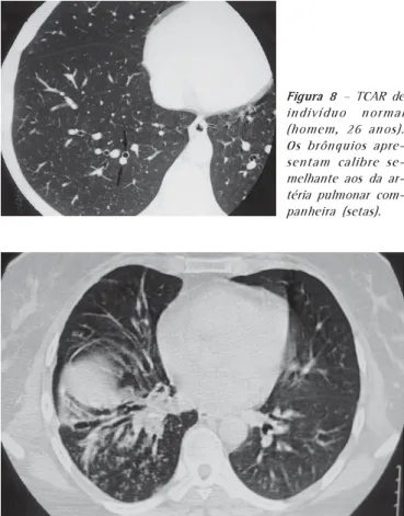 Figura 6  – Lesão consolidativa  (mu-lher,  28 anos).  A) Radiografia do tórax em PA mostrando  le-são consolidativa na projeção do lobo médio