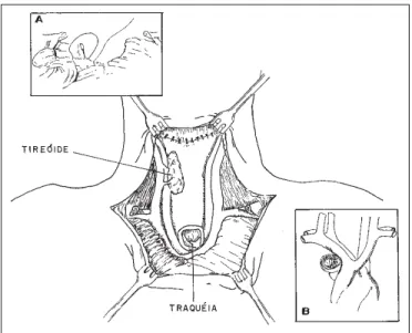 Figura 2 Traqueostomia bem cicatrizada