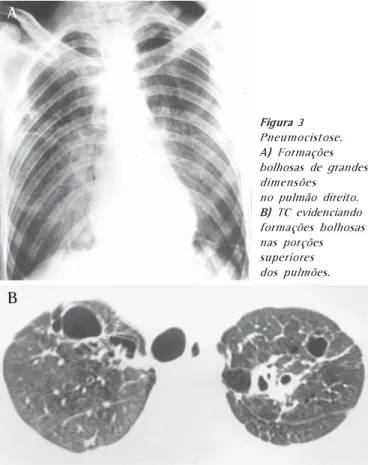 Figura 1 Pneumocistose. A) Infiltrado intersticial reticular fino, predominando nas regiões paracardíacas