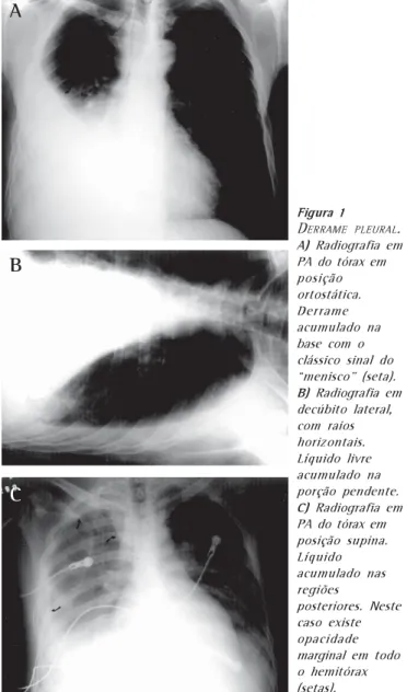 Figura 1 D ERRAME PLEURAL . A) Radiografia em PA do tórax em posição ortostática. Derrame acumulado na base com o clássico sinal do “menisco” (seta)