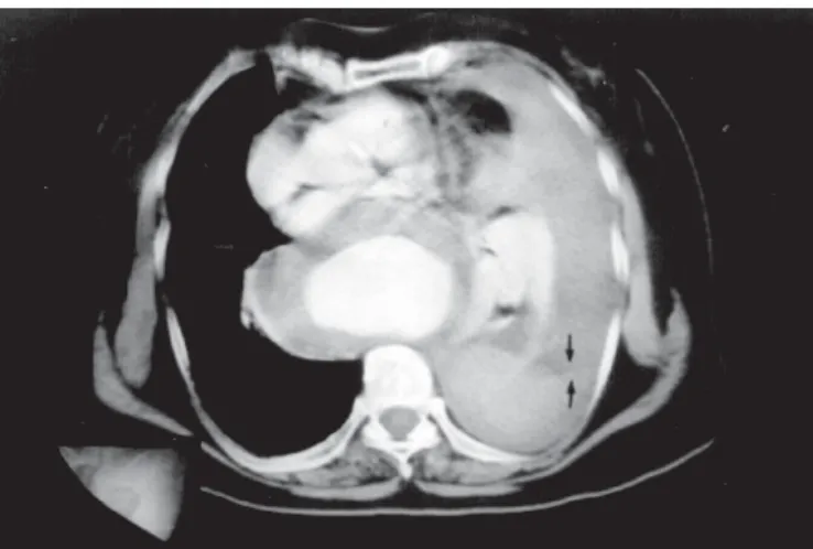 Figura 6 U LTRA - SOM NO DERRAME PLEURAL . A) Anecóico não homogêneo não septado. B) Anecóico não homogêneo septado