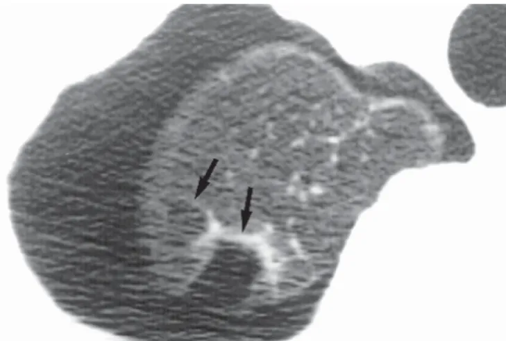 Figura 12 –  P NEUMOTÓRAX .  TCAR com cortes de 1mm de espessura no ápice pulmonar de homem de 18 anos, apresentando o 2º episódio de pneumotórax