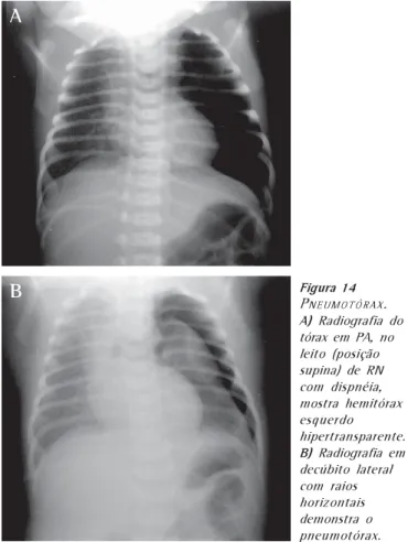 Figura 13 B OLHA HIPERTENSA SIMULANDO PNEUMOTÓRAX . Mulher de 33 anos. A parede fina da bolha simula a pleura visceral na radiografia em PA do tórax (seta), tomada em expiração na posição ortostática  (A)  e na TCAR (B)